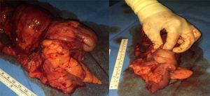Specimen from the right hemicolectomy, with the cecum occupied by the tumor that retracted the ileum and produced the invagination.