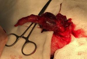 Appendiceal tumor.
