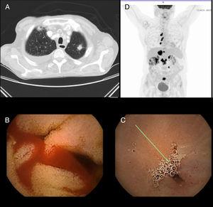 A) CT image in which a spiculated nodule in the left upper lobe suggestive of a primary lung tumor is identified. B) Capsule endoscopy image with angiodysplastic lesions in the jejunum with active bleeding. C) Capsule endoscopy image with jejunal stricture. D) PET image showing uptake in the mediastinal and peritoneal lymph nodes suggestive of dissemination.