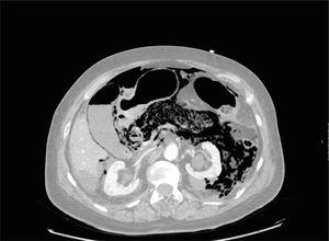 Axial CT view at the level of the pancreas, gallbladder, and upper poles of the kidneys showing emphysema in the pancreatic parenchyma that extends into the left perirenal and mesenteric fat, associated with ascitic fluid and pneumoperitoneum.