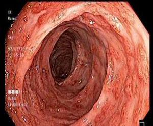 Colonoscopy: confluent polypoid lesions with hyperemic zones located in the descending colon.