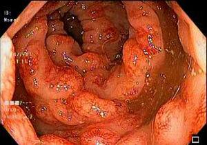 Colonoscopy: confluent polypoid lesions with hyperemic zones and thickened folds in the descending colon.