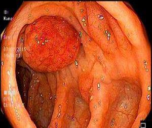 Colonoscopy: polypoid lesion in the ascending colon.