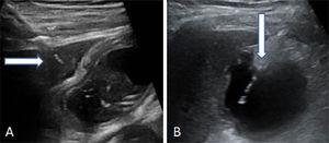 Two manners in which to carry out gallbladder puncture. (A) Transhepatic entrance of the needle. The arrow points to the hepatic dome. (B) Transperitoneal entrance of the needle directly into the fundus of the gallbladder.