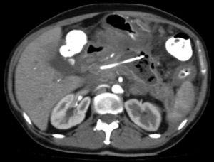 Abdominal tomography scan before the intervention. The walled-off necrotizing pancreatic collection is seen, with percutaneous pigtail catheter drainage. The presence of the pancreatic collection indicates the site of rupture of the main pancreatic duct.
