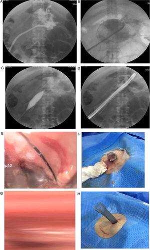 Fluoroscopic and endoscopic images during the procedure. A) The necrotized pancreatic cavity is enhanced with contrast medium. B) The esophageal fully covered self-expanding metal stent is inserted over the hydrophilic guidewire. C) Hydrostatic balloon dilation in the body of the esophageal stent is performed to enable the passage of the endoscope into the necrotized pancreatic cavity. D) Advancement of the endoscope into the necrotized pancreatic cavity. E) Endoscopic view of the area of necrosis. F) Extrusion of necrotic material after the endoscopic lavage. G) Image after the first endoscopic lavage. H) The exposed stent in place for further lavages.