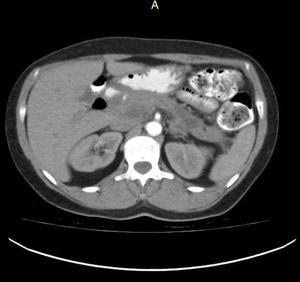 Control contrast-enhanced abdominal tomography scan, 3 months after the event, showing a decrease in edema and inflammatory pancreatic involvement, as well as a single residual collection with no radiologic signs of associated superinfection. The patient was completely asymptomatic when the scan was taken.
