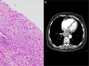 A) Histologic findings showing severe dysplasia/intraepithelial squamous cell carcinoma. B) Radiologic findings of the CT scan of the chest and abdomen. Arrow: Thickening of the distal esophagus.