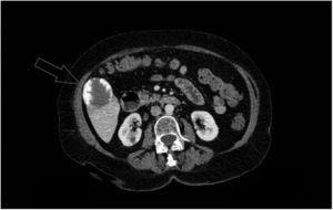 Axial view of the abdominal CT scan with iv contrast medium: focal lesion with peripheral nodular enhancement (approximately 5.1×4.6cm) located in liver segment V, consistent with an exophytic hemangioma.