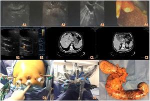 A1-A4) Endoscopic ultrasound images. B1-B2) Abdominal ultrasound. C1-C2) Contrast-enhanced abdominal tomography. D1-D2) Positioning of the trocars and docking of the robot. E) Surgical specimen.