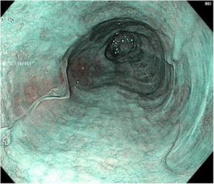 Chromoendoscopy 3 weeks after the initial presentation, showing re-epithelialization of the mucosa and spontaneous resolution of the esophageal hematoma.