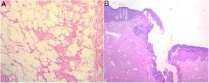 Histologic images. (A) Mature white adipose tissue with no atypia. (B) The fistulous tract, with mostly variable scarring and inflammatory and granulation tissue.