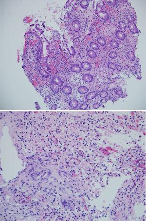 A) H & E stain at x200: Sample from the duodenum: active chronic inflammation. B) Image at x400: Ulcer with marked lymphoplasmacytic infiltrate, with no signs of malignancy.