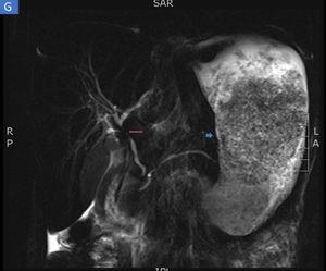 Magnetic resonance enterography identifying severe inflammatory changes and thickening of the stomach (short arrow), as well as the incidental identification of a severe stricture, with an inflammatory aspect, at the confluence of the hepatic ducts and the proximal common bile duct, consistent with primary sclerosing cholangitis (long arrow).