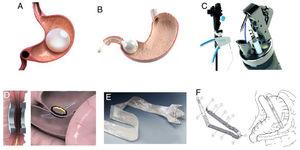 Some of the more widely studied devices and methods that have shown promising results. A) Intragastric balloon, B) BARONova, C) Apollo OverStitch, D) Incisionless Magnetic Anastomotic System (IMAS), E) EndoBarrier, F) BariClip.