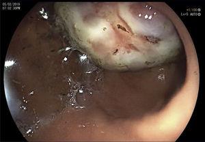 Endoscopic image showing the tumor in the gastric antrum.