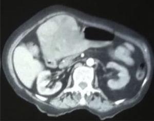 Contrast-enhanced abdominal CAT scan showing the liver tumor invading the gastric chamber. The lesion is heterogeneous and located in segment IV of the liver.