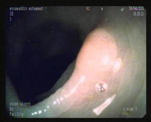 Polyp detected by the i-SCAN technique.