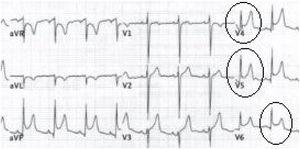 Electrocardiogram showing diffuse ST-segment elevation in the precordial leads.