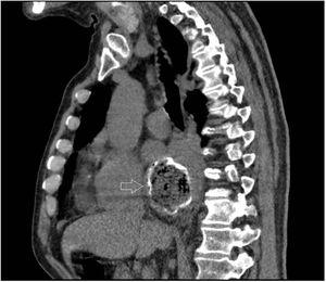 Sagittal view of the chest CT scan. The arrow indicates the calcified esophageal diverticulum with intraluminal material, directly behind the heart.