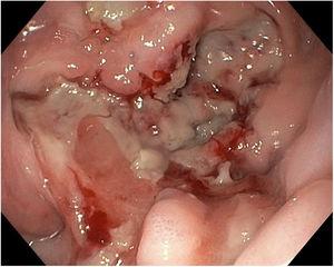 Endoscopic image of the epiphrenic diverticulum after the removal of the intraluminal foreign bodies. Friable mucosa and several decubitus lesions on the adjacent surface can be seen.