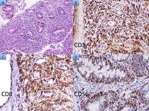 A) Hematoxylin and eosin ×20: Dense lymphoid infiltrate composed of medium-sized monomorphic lymphoid cells. B, C, and D) Neoplastic cells express the CD3, CD8, and CD56 markers, respectively.