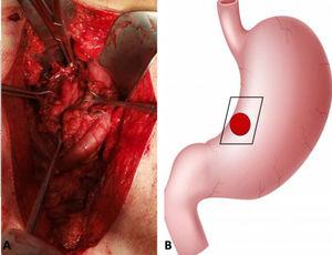 A) Rupture of the stomach in the lesser curvature, measuring 5 × 5 cm. B) Illustration. The red circle is the perforation site. The black rhombus indicates the resection margins.