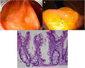 Sessile serrated adenoma/polyp. A) A mostly flat sessile serrated polyp in the right colon. Note the color similar to that of the adjacent normal colon, the paucity of blood vessels on the surface of the lesion, and the accumulation of yellow “debris” at the edges. B) A sessile serrated polyp in the right colon. Note the prominent “yellow mucus cap.” C) Histologic appearance of a sessile serrated adenoma/polyp. It has distorted crypt architecture, with marked serration at the base of the crypts; basal crypts are dilated. (endoscopic images taken with authorization: Rex D. Serrated Polyps in the Colon. Gastroenterol Hepatol 2014; 10 (10). Histologic image was taken with authorization: Kuo E. Sessile serrated adenoma [accessed July 2, 2020]. Available at: http://www.pathologyoutlines.com/topic/colontumorsessileserrated.html.