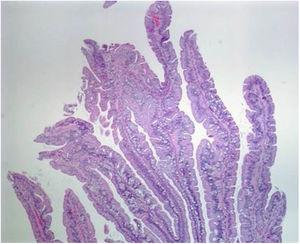 Histologic section of a traditional serrated adenoma, showing a protuberant villiform growth pattern with slit-like serrations. Taken from: Kuo E, Gonzalez R. Traditional serrated adenoma [accessed July 2, 2020]. Available at: http://www.pathologyoutlines.com/topic/colontumortraditionalserratedadenoma.html.