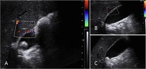 Ultrasound signs of acute cholecystitis. (A) Augmented gallbladder vascularity, (B) Increased wall thickness, and (C) Cholelithiasis.