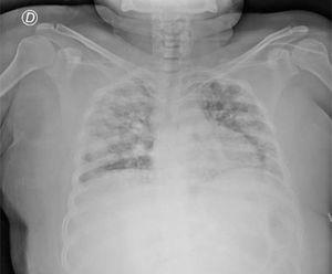 Chest x-ray with multiple bilateral infiltrates.