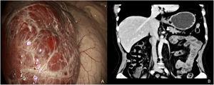 (A) Laparoscopic image of the procedure with a view of the left liver lobe and giant hemangioma. (B) Coronal view of the computed tomography scan, 12 months after the surgical procedure, showing the absence of lateral segments II and III, from the falciform ligament.