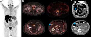 (A) Maximum intensity projection (MIP) 18F-choline PET/CT, (B) PET/CT axial views of the prostatic lesion, hypermetabolic adenopathies, and bone infiltration, as well as of the tumor of the colon, and (C) virtual colonoscopic biopsy, confirming colon tumor malignancy.