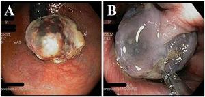 Endoscopy. (A) Anal mass viewed during the rectal retroflexion maneuver. The pedunculated, mobile lesion enters into the rectum but does not affect the rectal mucosa. (B) The mass is dependent on the anal canal and a mucosal pedicle can be seen in the forward view. A sample is taken using a biopsy forceps.