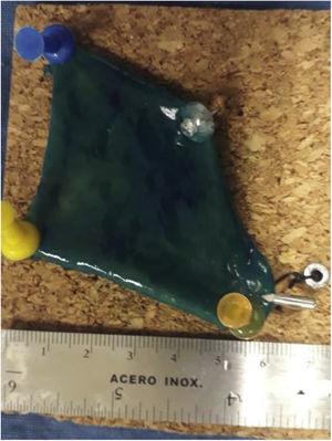 Specimen > 5cm retrieved in the en bloc resection of the lesion, with the internal magnet in situ.