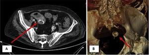 A) A computed tomography (CT) scan, showing regional inflammation and proximal ileum ectasia due to impaction of a round foreign body, 2 cm in diameter, at the terminal ileum. B) A 3D CT reconstruction image, showing a round foreign body, 2 cm in diameter, at the terminal ileum.