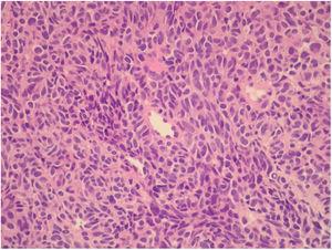 Histologic examination, showing solid proliferation of atypical cells, with no cytoplasmic pigment (H&E, x40).