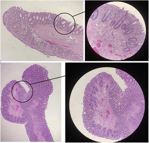 Pathologic image showing digitiform, polypoid formations, no dysplasia, and the presence of acute and chronic inflammation, with focal abscesses, consistent with perforation.