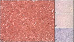 Immunohistochemical technique, in which the cells express smooth muscle actin (A) and are negative for C-kit (B) and S100 (C), with a low Ki67 proliferation index (D).