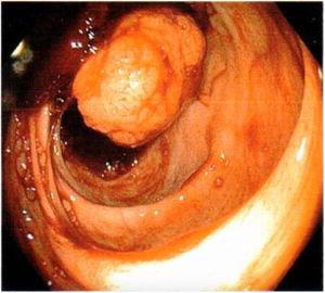 Colonoscopy image, showing a sessile polyp in the cecum, occluding 30% of the intestinal lumen.