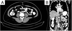Axial (A) and coronal (B) views of double-contrast computed tomography, showing an exophytic hypodense lesion in the cecum, dependent on the medial wall, measuring 31 × 40 × 30 mm, with poor enhancement, after contrast medium administration. The lesion can be seen infiltrating the ileocecal valve and the base of the cecal appendix.