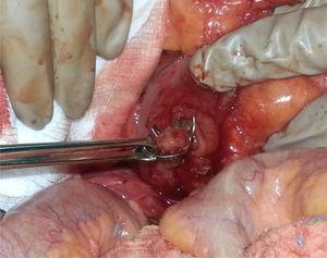 Extraction of the closed OVESCO system, occluding the intestinal wall and trapping the endoscopic forceps.