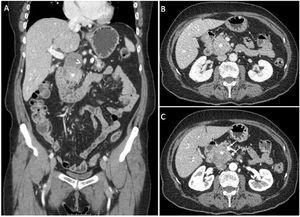 Contrast-enhanced coronal (A), and axial (B) CT images in the portal venous phase, showing a hypodense mass in the pancreatic head (A-B-C-asterisk), accompanied by peripancreatic lymphadenopathy just superior to the mass (A-arrowhead). Note the patency of the superior mesenteric artery and the splenic vein in the arterial phase (C-arrows).