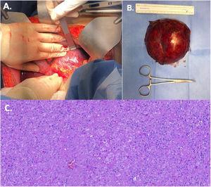 A) Intraoperative finding of a large hepatic tumor in the caudate lobe. B) Resected 10cm hepatic tumor. C) Hepatocellular carcinoma, tumor cells arranged in thin trabeculae, with a replacing growth pattern.
