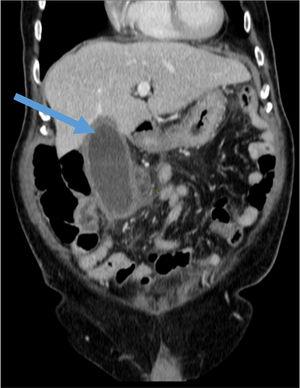 Hydropic gallbladder with wall thickening (arrow) and marked inflammatory changes in the pericholecystic fat; reactive adenopathies in the hepatic hilum; findings related to acute cholecystitis.