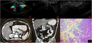 A) Endoscopic ultrasound with main pancreatic duct measurement. A1) Neck 7 mm. A2) Body 10 mm. A3) Tail 3 mm (intraductal calcifications in body and tail). B1-B2) Contrast-enhanced abdominal computed tomography scan. C) Histopathology: chronic pancreatitis with extensive fibrosis associated with chronic inflammation.