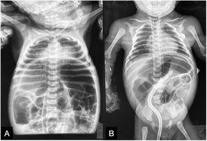 A) Intestinal segment dilation. B) Improvement of the restrictive thoracic pattern after orogastric and transrectal tube placement.