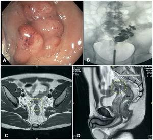 (A) Colonoscopy showing a rectal mass obstructing 100% of the rectal lumen, located 7cm above the anal verge. (B) Fistulography performed through cystoscopy showed contrast in the distal portion of the sigmoid colon and superior rectum. (C and D) Initial T2-weighted magnetic resonance imaging, showing a tumor in contact with the posterior wall of the urinary bladder.