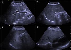 Liver and bile duct ultrasound imaging, showing gallstones and no intrahepatic or extrahepatic bile duct dilation. A) Nondilated common bile duct measuring 4 mm in diameter. B and C) Gallbladder containing multiple stones. D) Nondilated intrahepatic bile duct.
