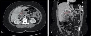Initial computed tomography scans. A) Axial and B) coronal views of the pseudoaneurysm identified as a gallstone (red arrows).